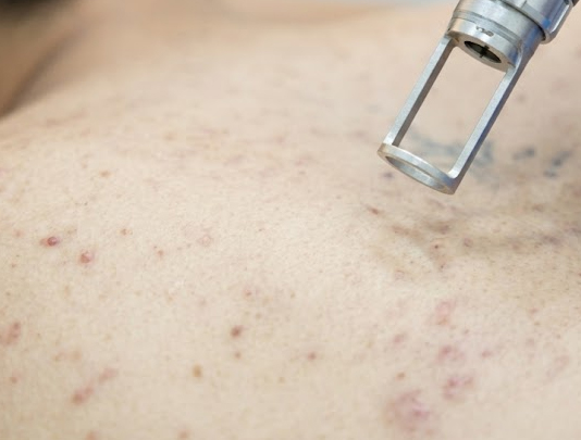 Picosure Laser