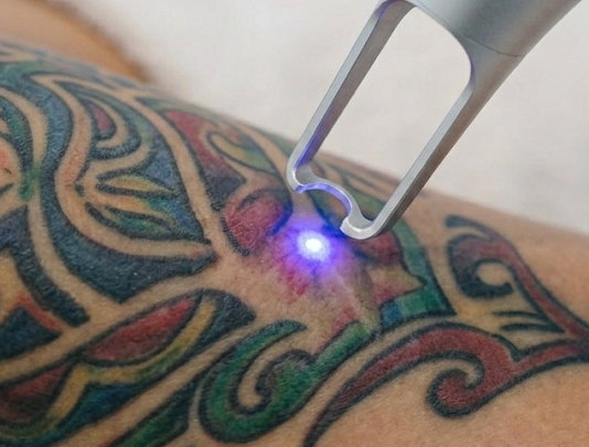 Removal Tattoo Laser
