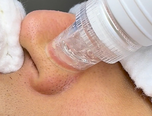 Clear Skin Pore Treatment