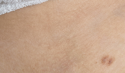 Essential Signature Permanent Hair Removal