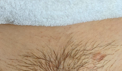 Essential Signature Permanent Hair Removal