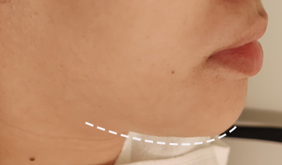 7D Hifu Treatment