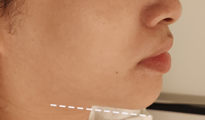 7D Hifu Treatment