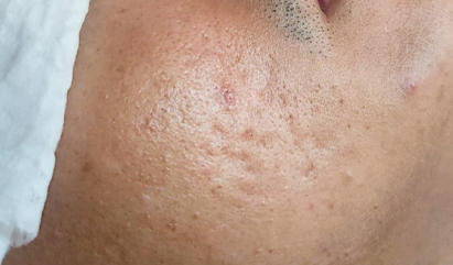 Skin Refining Treatment