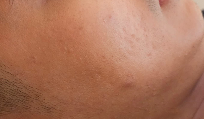 Skin Refining Treatment